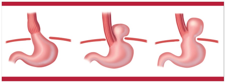 hiatal_laparoscópica_2