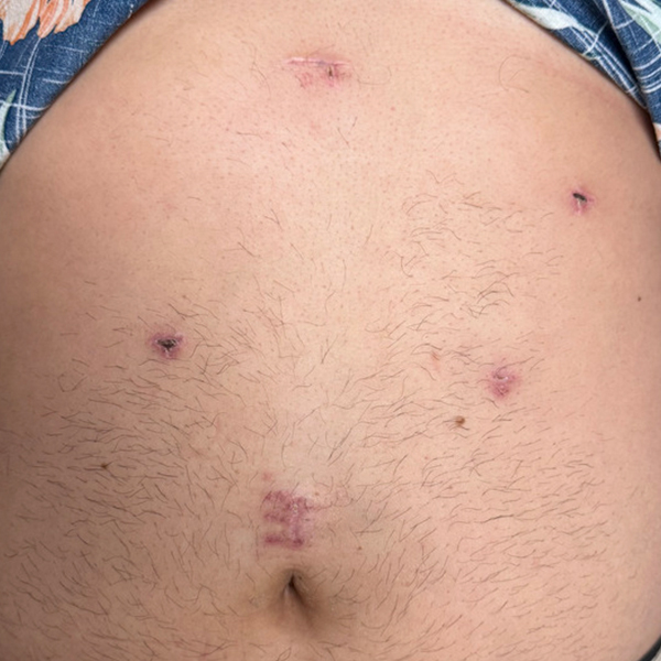 hiatal_laparoscópica_3