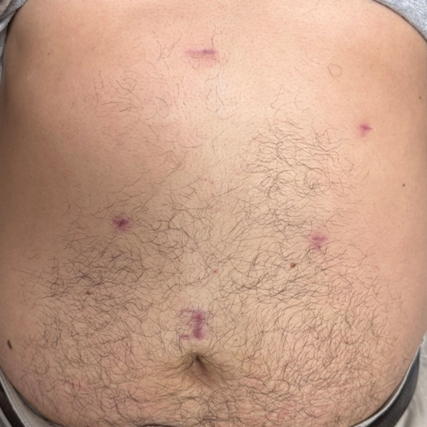 hiatal_laparoscópica_4