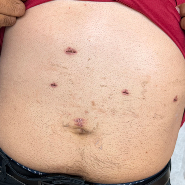 hiatal_laparoscópica_5