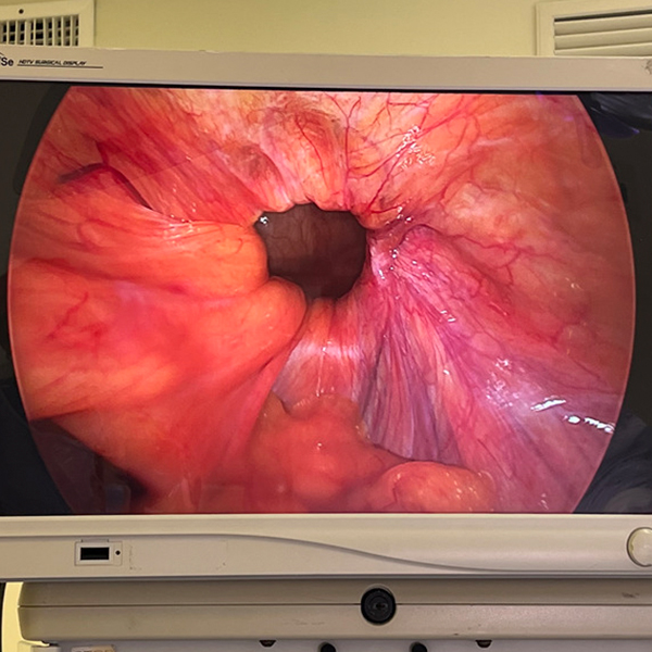 inguinal_laparoscópica_1