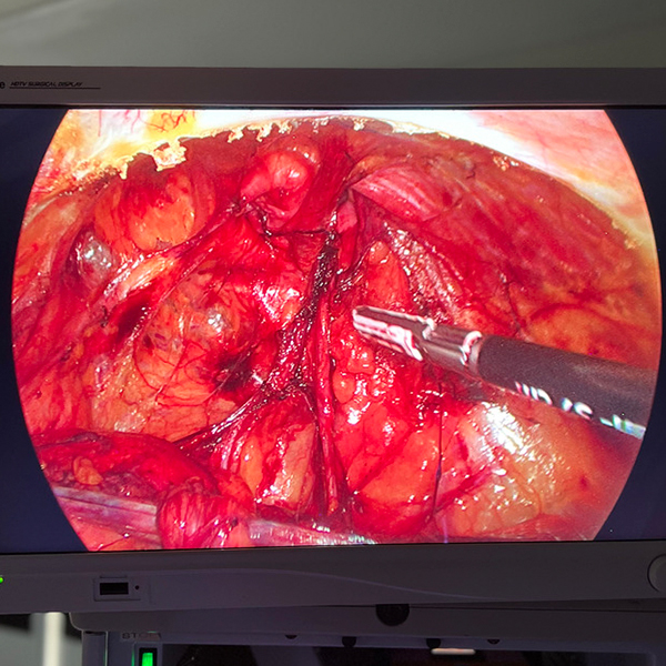 inguinal_laparoscópica_2