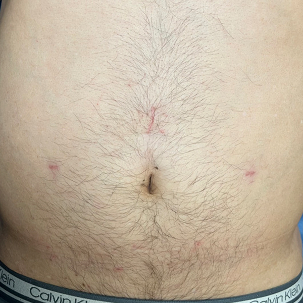 inguinal_laparoscópica_3