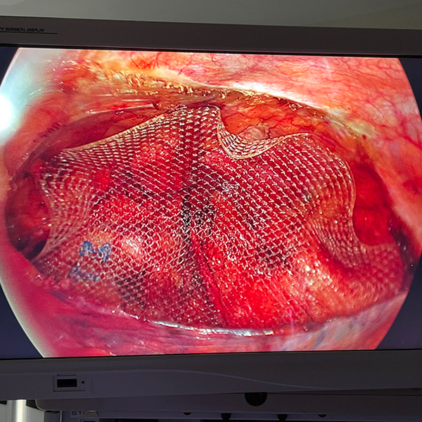 inguinal_laparoscópica_TAPP_2