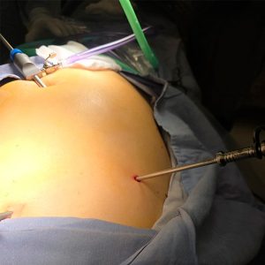 minilaparoscopia_2