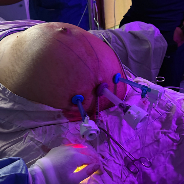 umbilical_laparoscópica_1